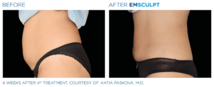 Emsculpt_Emtone_PIC_Ba-card-female-abdomen-002_EN100