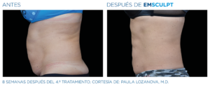 Emsculpt_Emtone_PIC_Ba-card-female-abdomen-002_EN1001