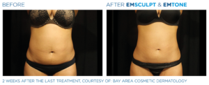Emsculpt_Emtone_PIC_Ba-card-female-abdomen-002_EN1004